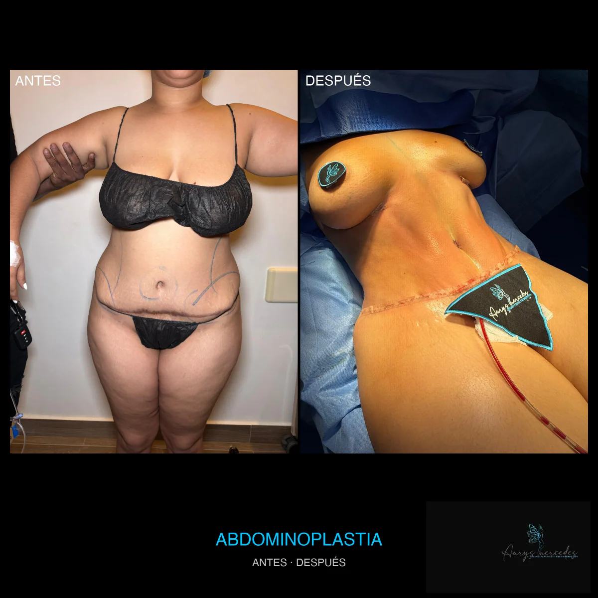 Caso publicado de Abdominoplastia, antes y después, caso 1