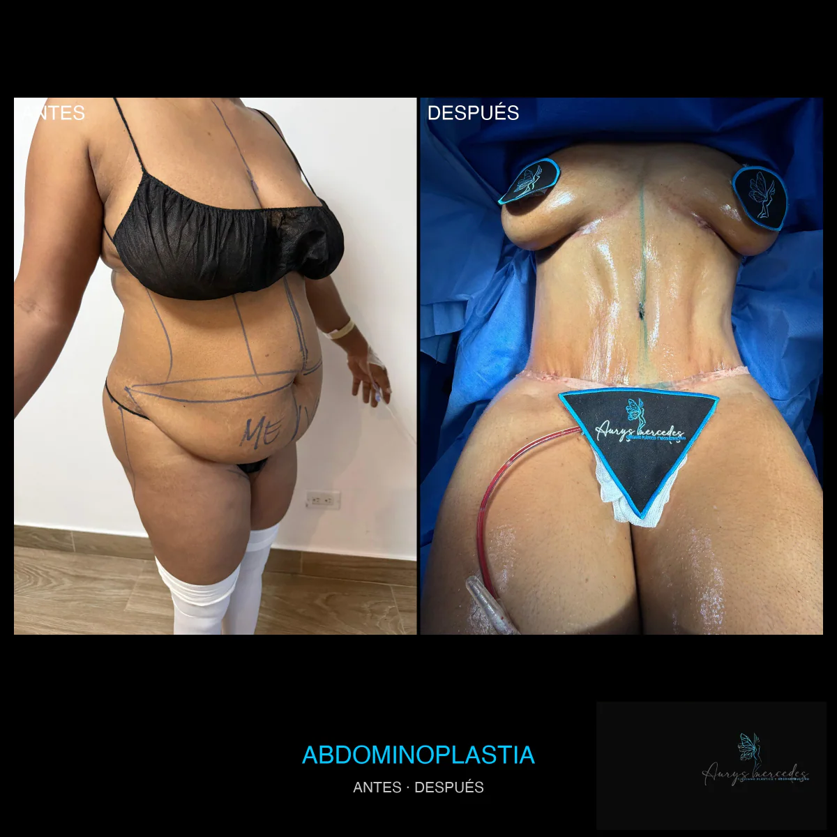 Caso publicado de Abdominoplastia, antes y después, caso 3