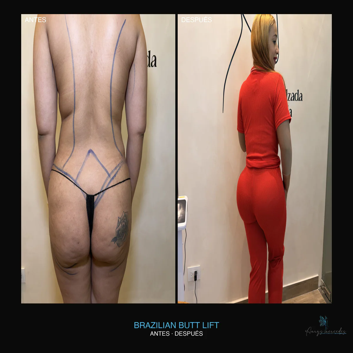 Caso publicado de Brazilian Butt Lift (BBL), antes y después, caso 1