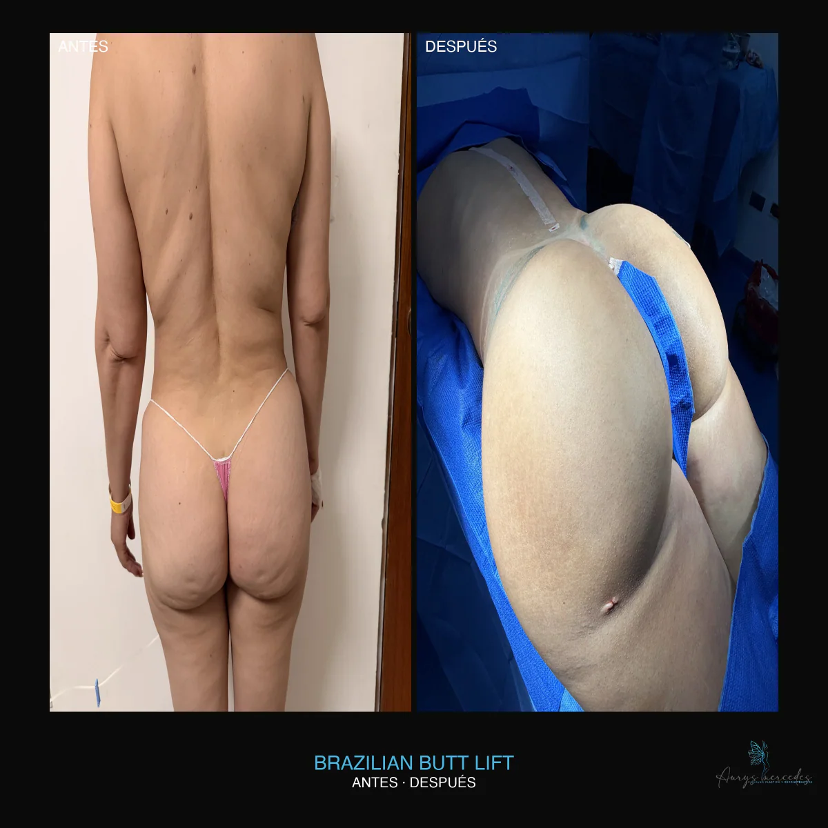Caso publicado de Brazilian Butt Lift (BBL), antes y después, caso 2