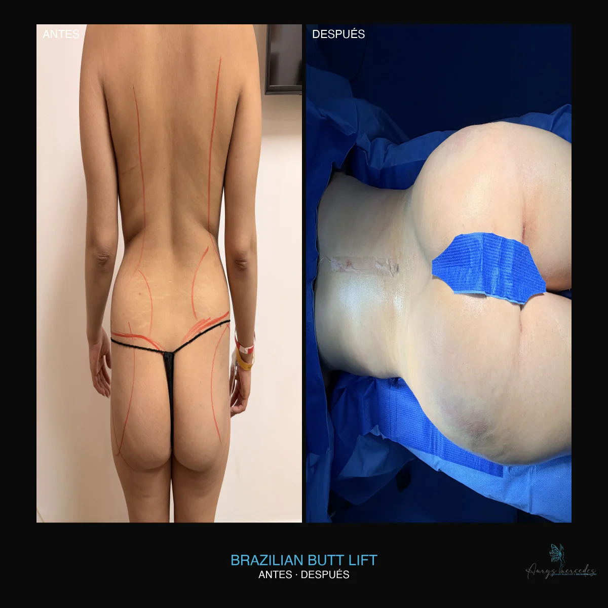 Caso publicado de Brazilian Butt Lift (BBL), antes y después, caso 3