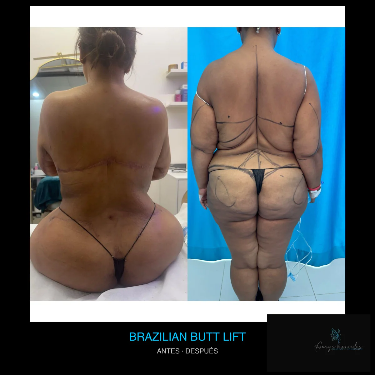 Caso publicado de Brazilian Butt Lift (BBL), antes y después, caso 4