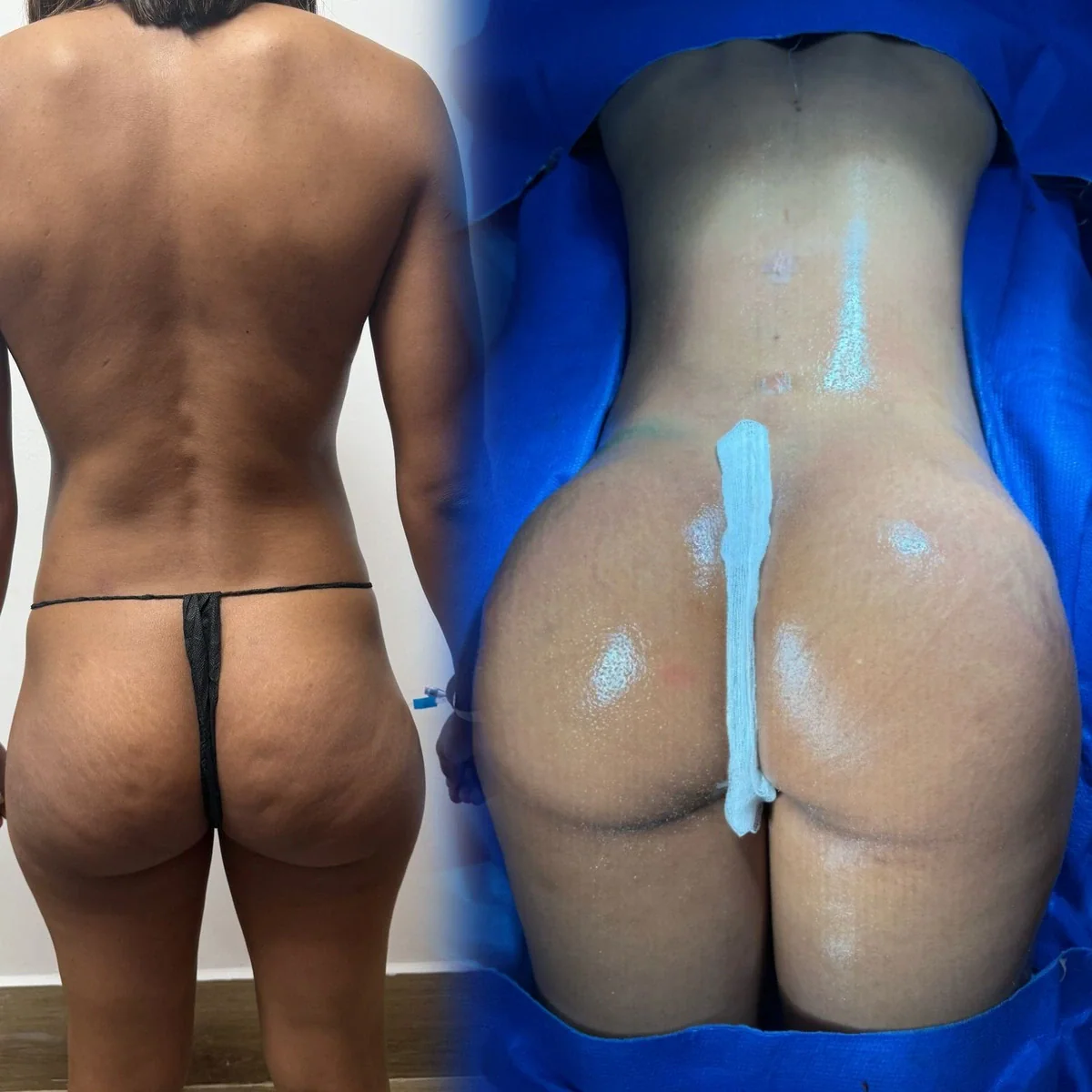 Caso publicado de Brazilian Butt Lift (BBL), antes y después, caso 5