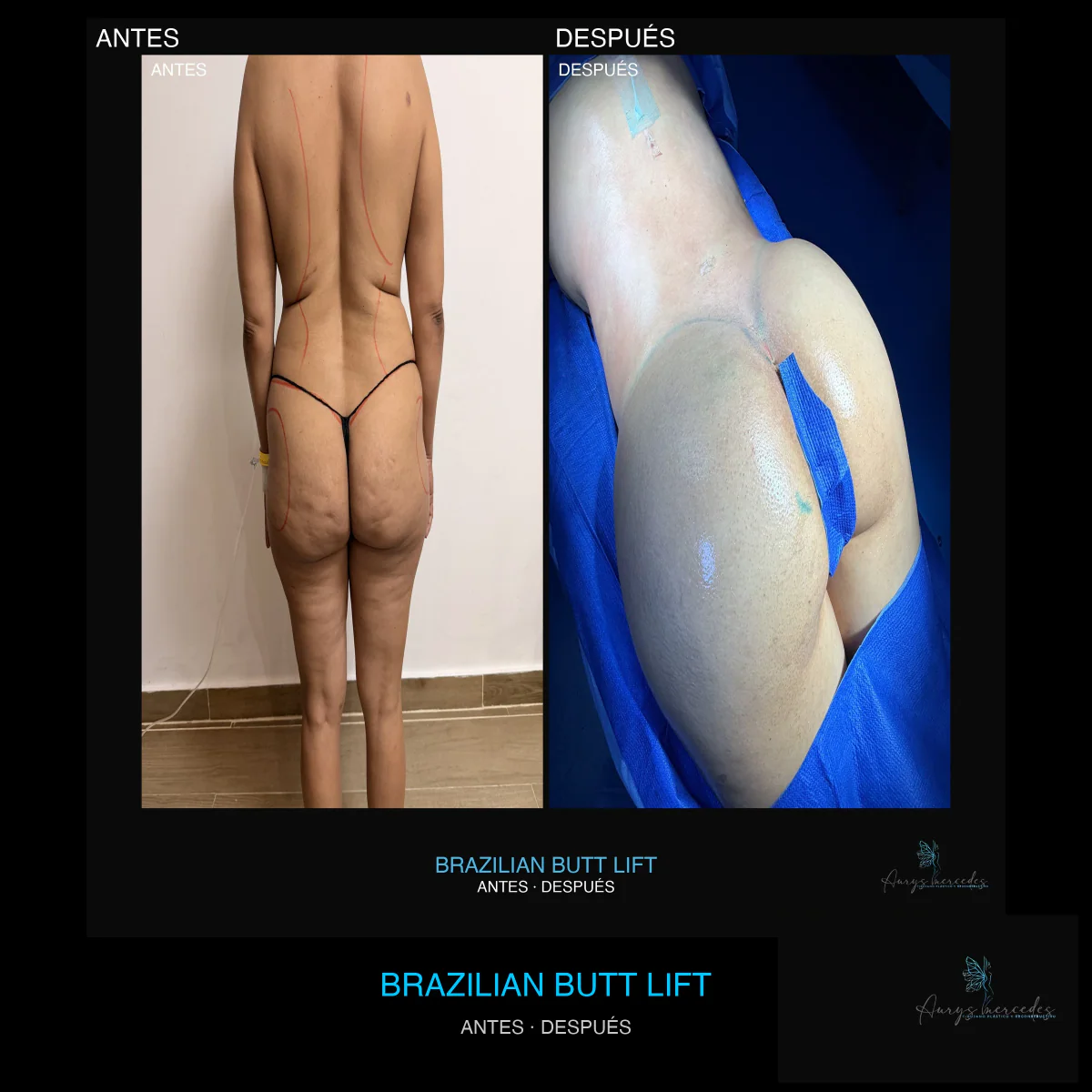Caso publicado de Brazilian Butt Lift (BBL), antes y después, caso 6