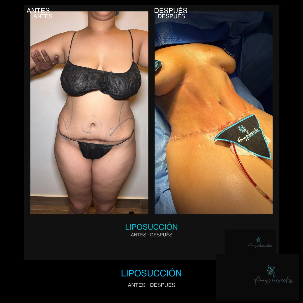 Caso publicado de Liposucción, antes y después, caso 1