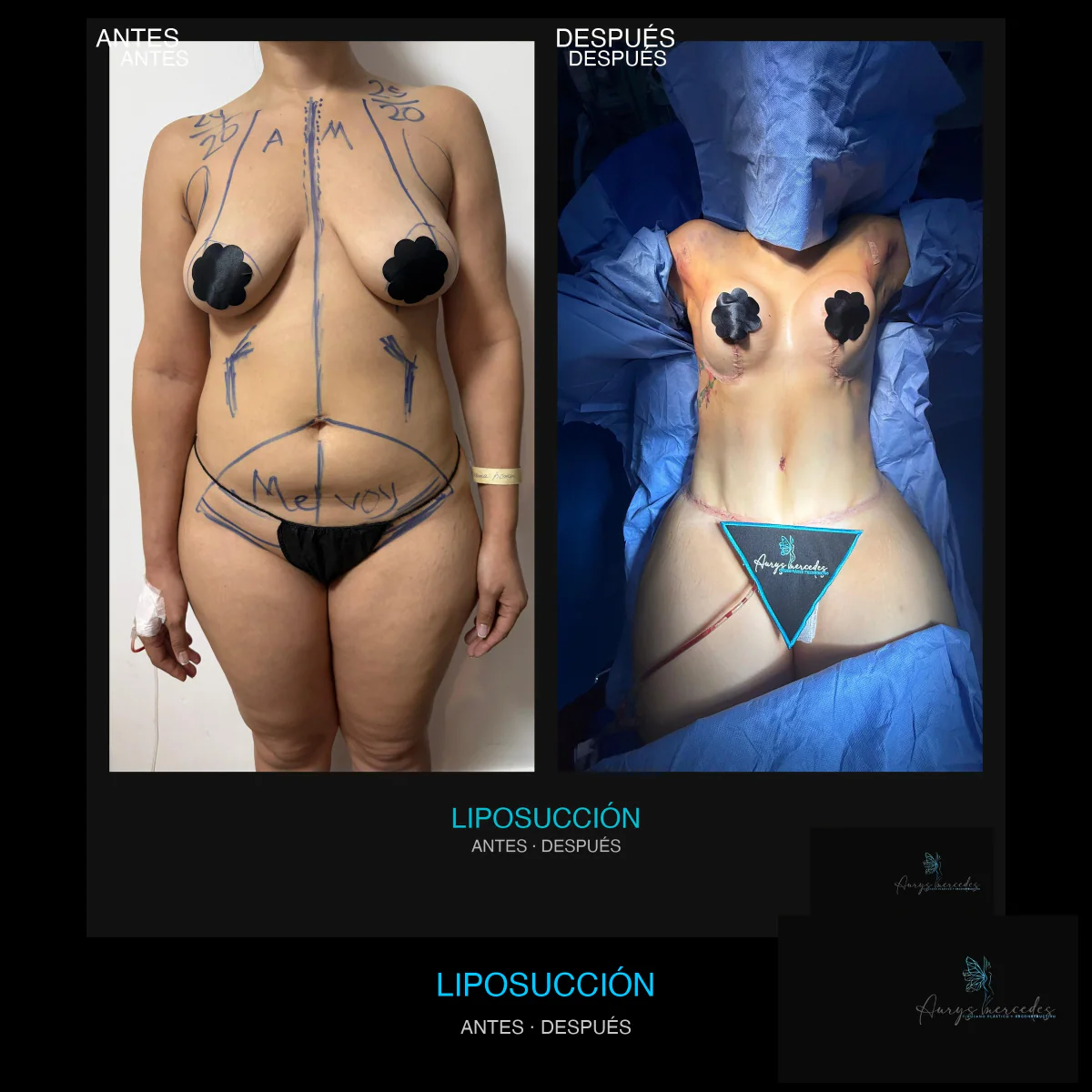 Caso publicado de Liposucción, antes y después, caso 2