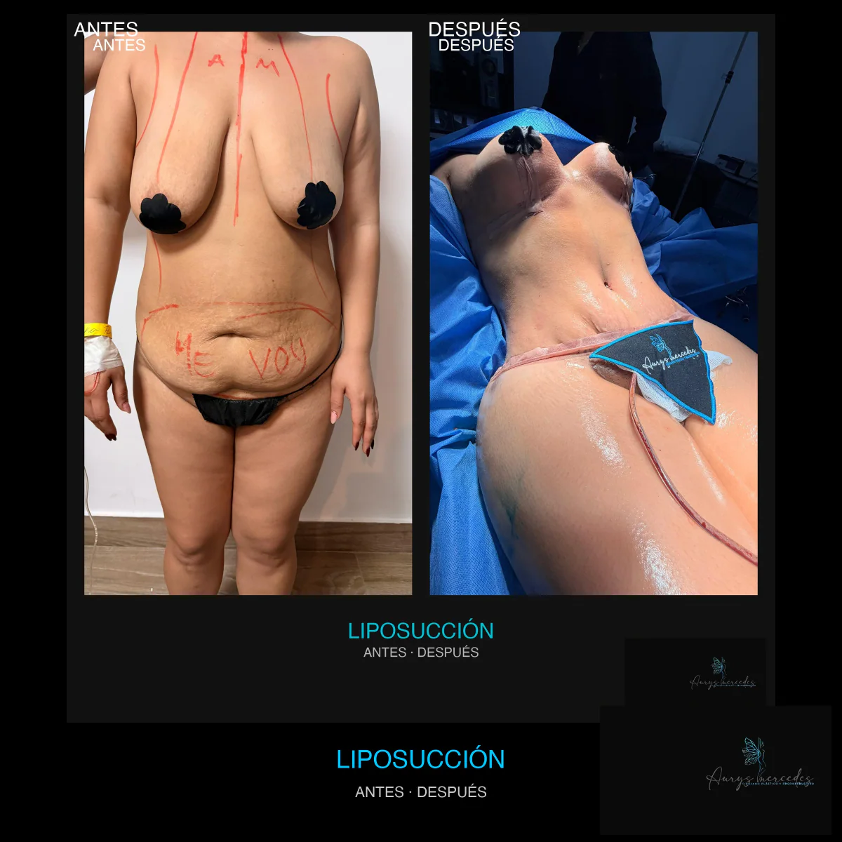 Caso publicado de Liposucción, antes y después, caso 3