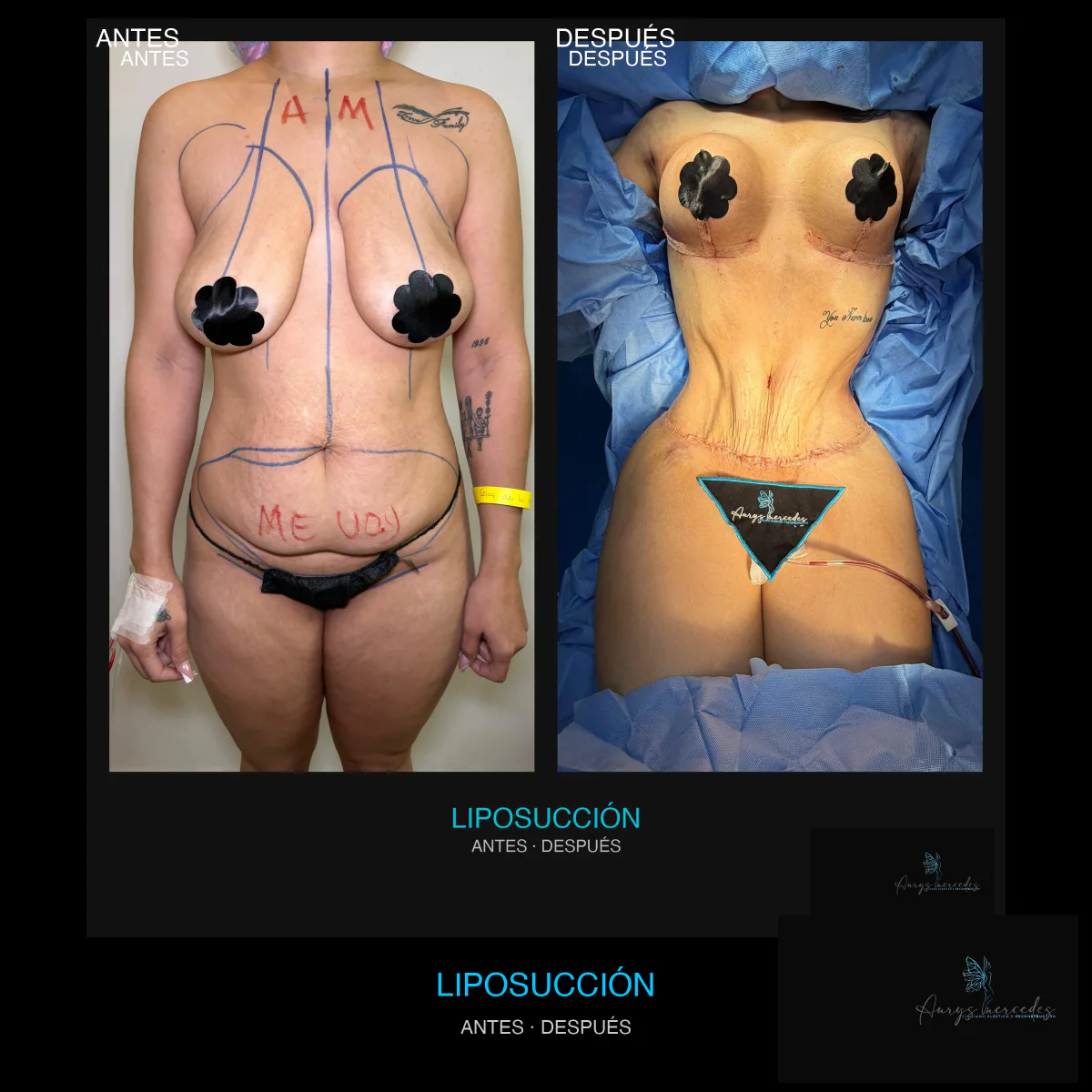 Caso publicado de Liposucción, antes y después, caso 8