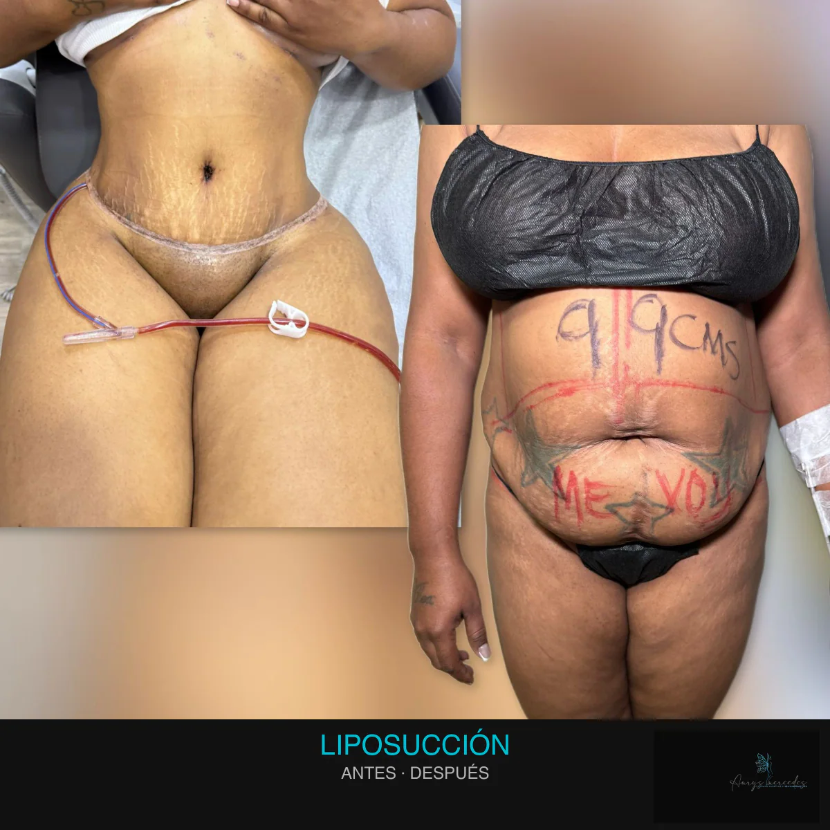 Caso publicado de Liposucción, antes y después, caso 10