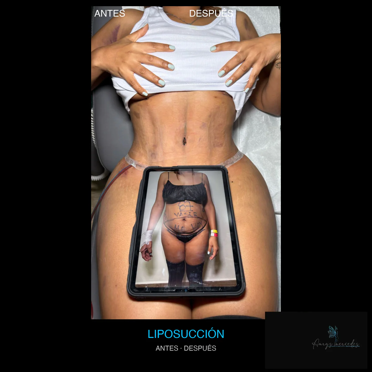 Caso publicado de Liposucción, antes y después, caso 11