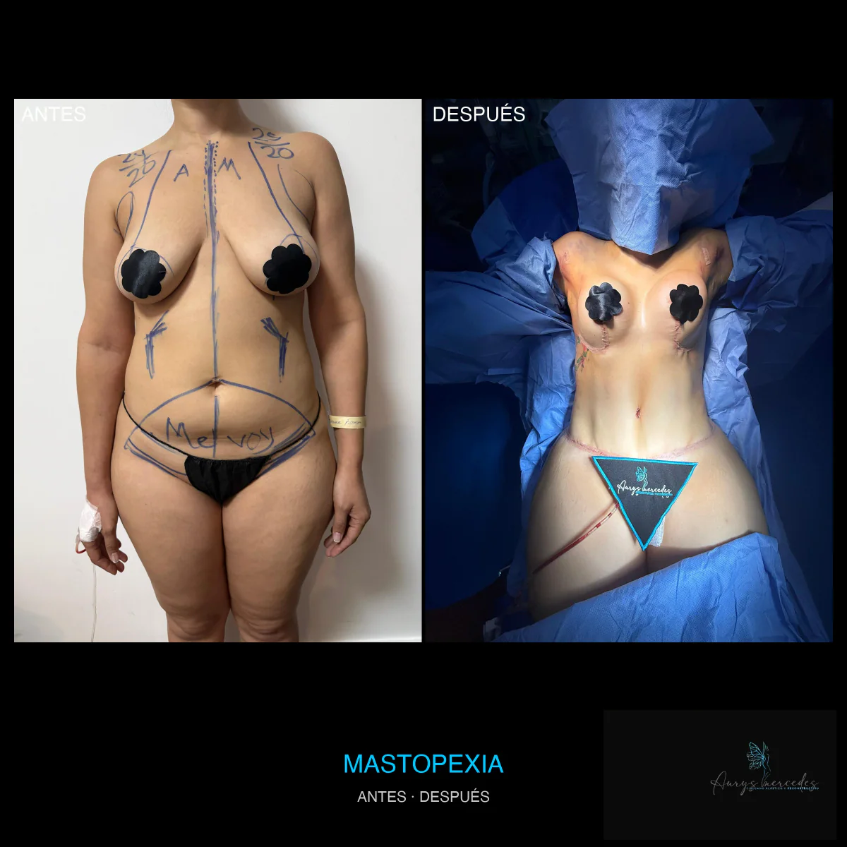 Caso publicado de Mastopexia y mamoplastia, antes y después, caso 1