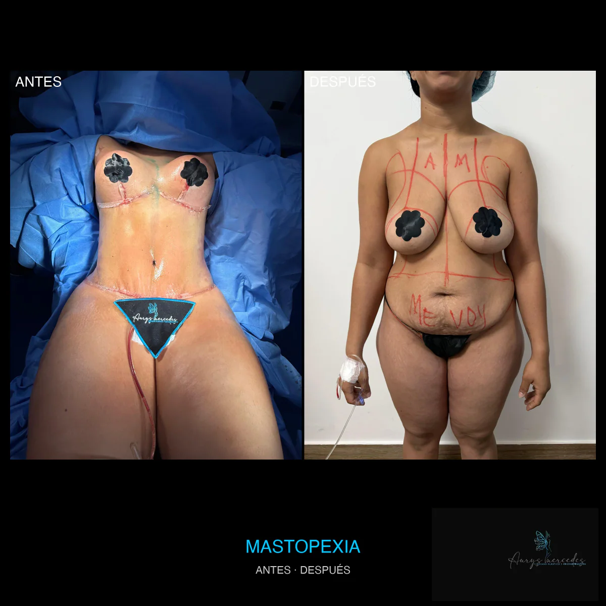 Caso publicado de Mastopexia y mamoplastia, antes y después, caso 3