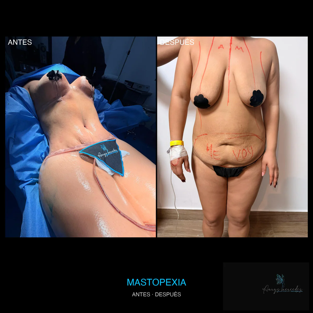 Caso publicado de Mastopexia y mamoplastia, antes y después, caso 5